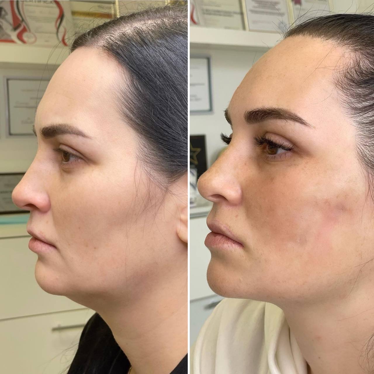 chin augmentation dr tatiana(7)