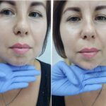 chin augmentation dr tatiana