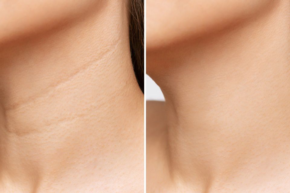 Neck Rejuvenation