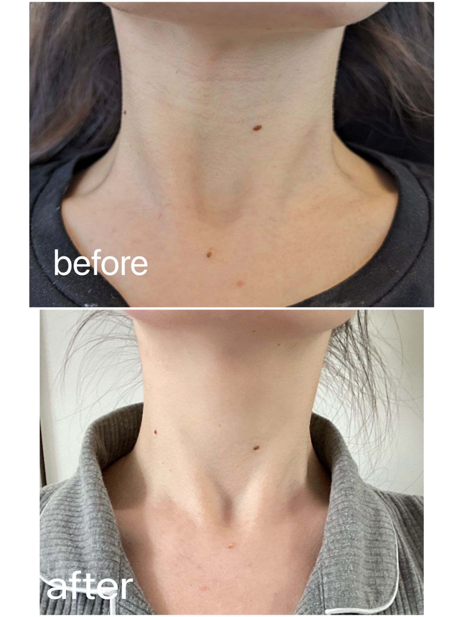 Neck Rejuvenation