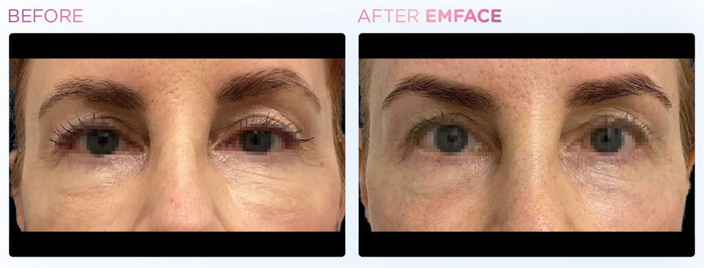 Emface -eyes -before-and-after (1)