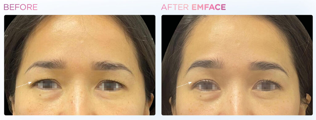 Emface -eyes -before-and-after (2)