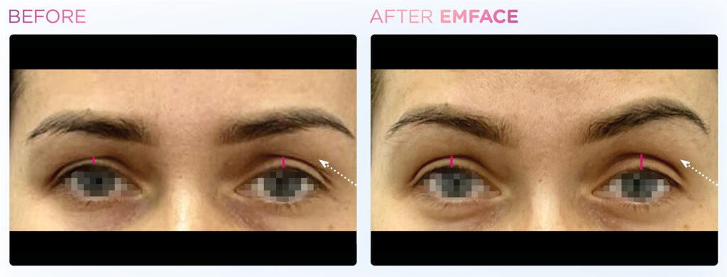 Emface -eyes -before-and-after (3)