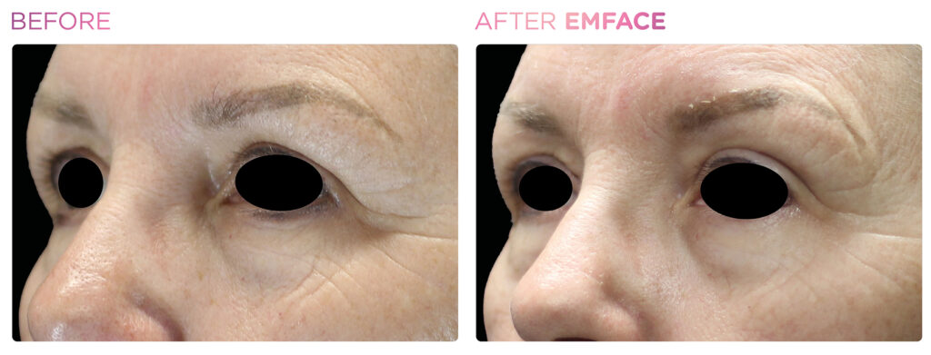 Emface -eyes -before-and-after (4)