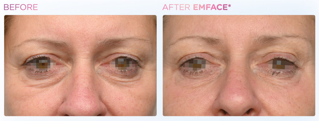 Emface -eyes -before-and-after (5)