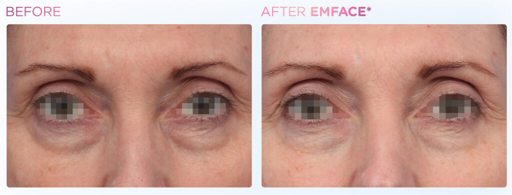 Emface -eyes -before-and-after (6)